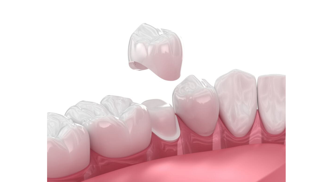 Dental crowns