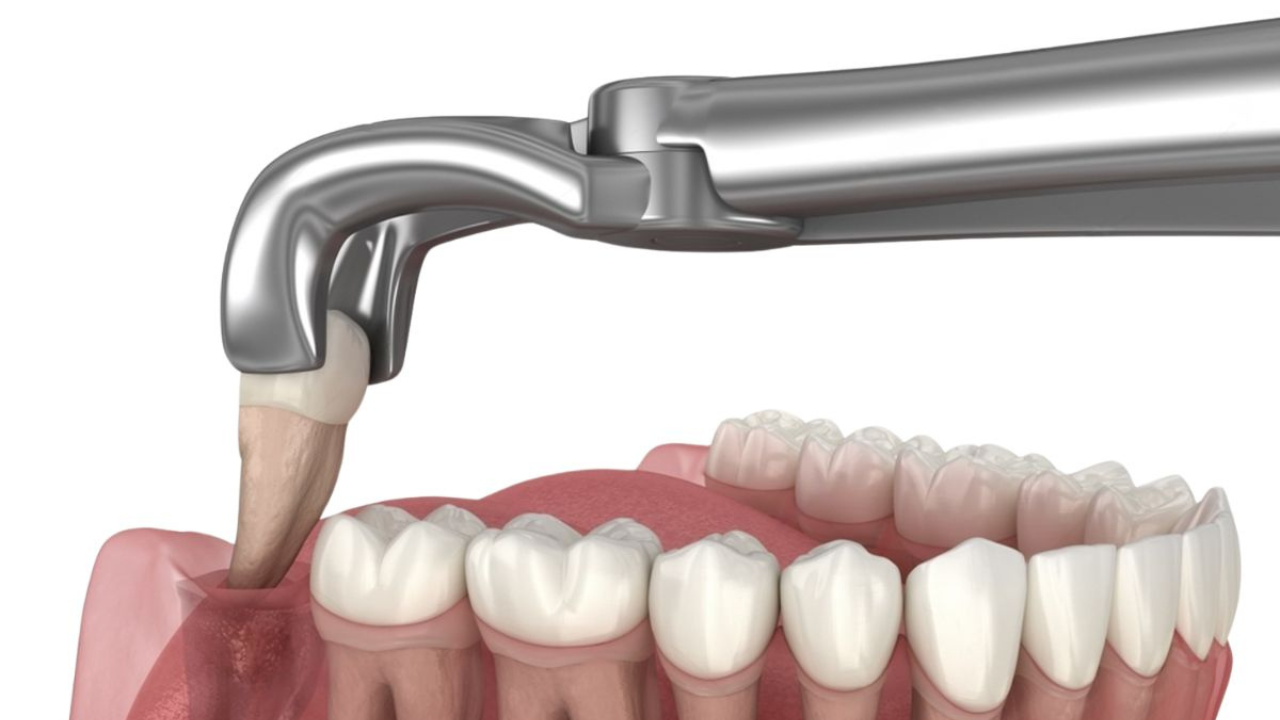 Invisalign for crowded teeth without extractions, before and after