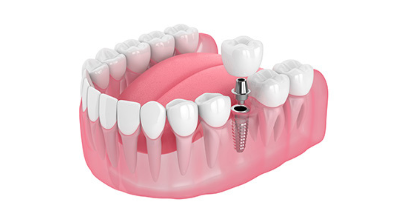 Dental implants