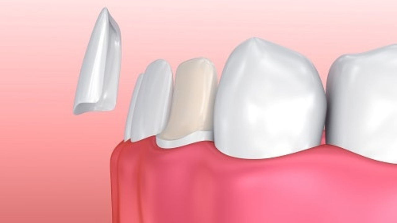 Porcelain veneers